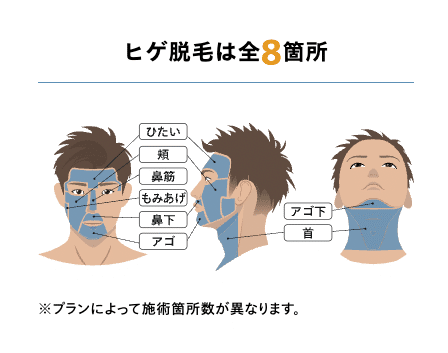 レジーナクリニックオムヒゲの施術箇所