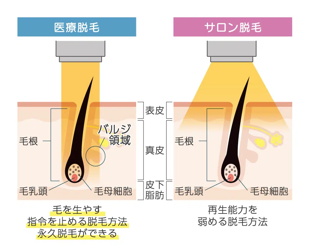 医療脱毛とサロン脱毛の脱毛レーザーの違い