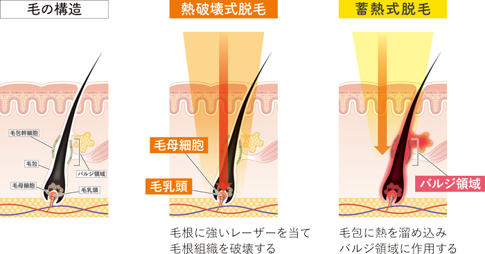 熱破壊式と蓄熱式の脱毛方式の紹介画像