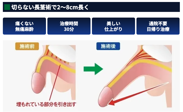 MSクリニックの切らない長茎術に関するイメージ画像