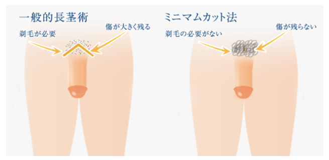 メンズライフクリニックの長茎術(ミニマムカット法)に関する画像
