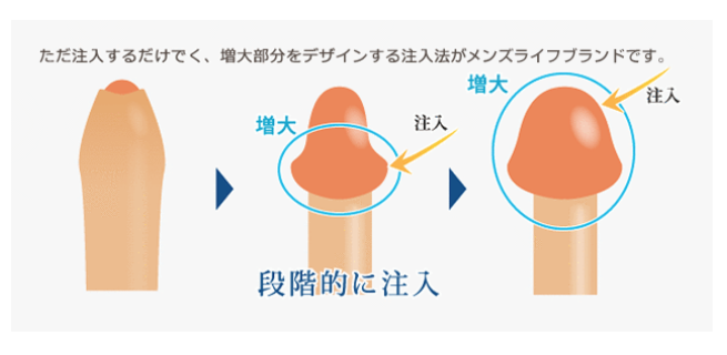 メンズライフクリニックの亀頭増大に関する画像