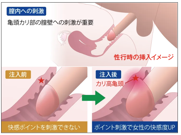 MSクリニックの亀頭増大に関するイメージ画像