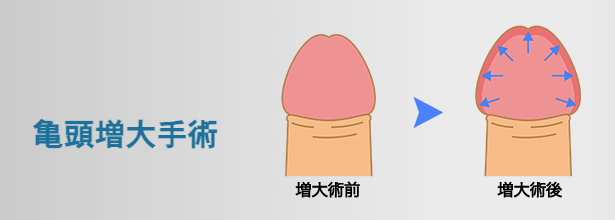 東京上野クリニックの亀頭増大に関する画像