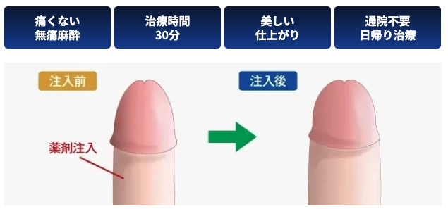 MSクリニックの陰茎増大術に関するイメージ図