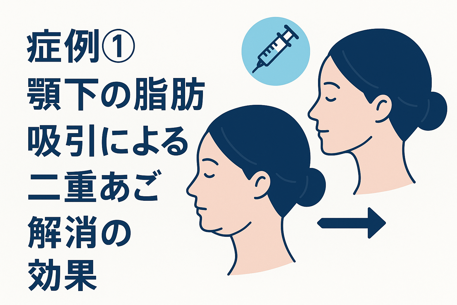 症例①:顎下の脂肪吸引による二重あご解消の効果