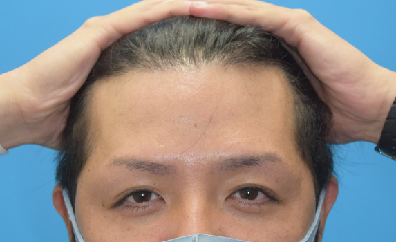 自毛植毛の施術後（FUE1420グラフト）