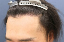 アルモ形成クリニックの生え際・他院修正・1200グラフトの術後の症例写真