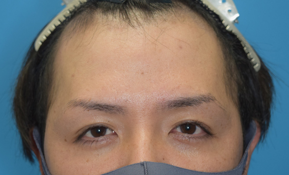 自毛植毛の施術前（FUE1420グラフト）