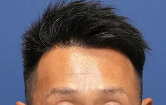 親和クリニックMIRAI法1500株の術後の症例写真