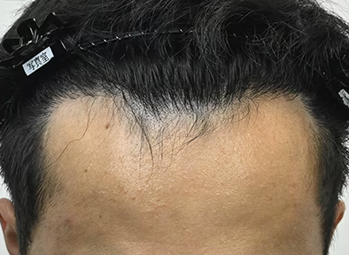 湘南AGAクリニックスマートFUE法の術後の症例写真