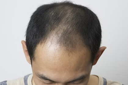 自毛植毛の施術前(自毛植毛)