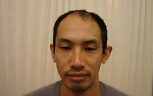 自毛植毛の施術前(ニードル法)