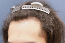 アルモ形成クリニックの生え際・他院修正・1200グラフトの術前の症例写真