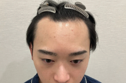 東京植毛美容外科のFUE法の術前の症例写真
