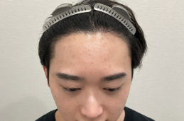 東京植毛美容外科のFUE法の術後の症例写真