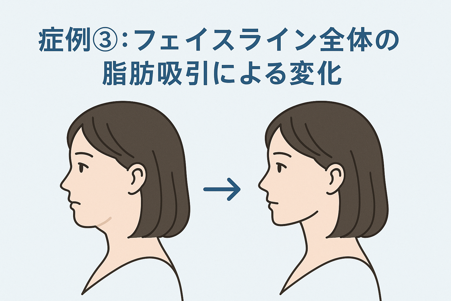 症例③:フェイスライン全体の脂肪吸引による変化