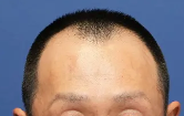 親和クリニックMIRAI法1500株の術前の症例写真